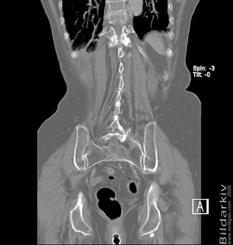 CT colon 41
